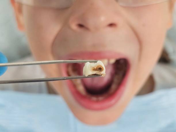 Best Broken or Chipped Tooth Repair in Taft, CA